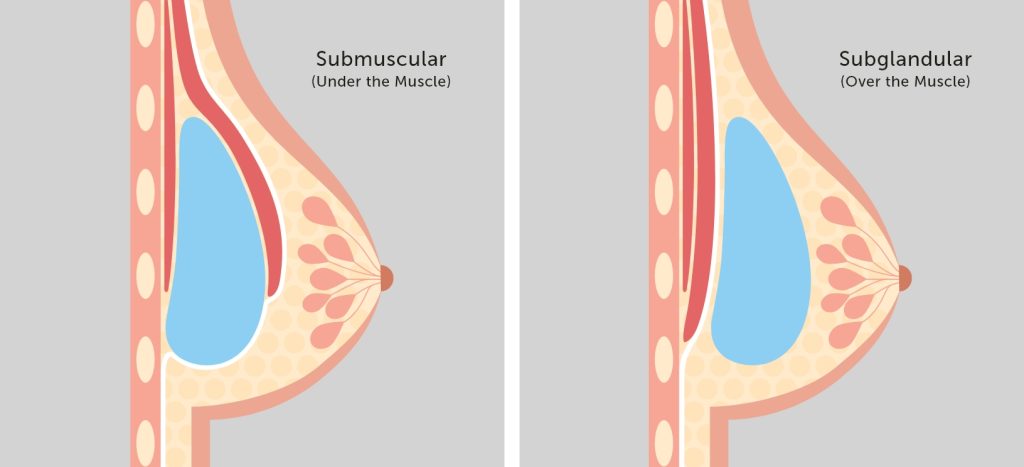diagram of subglandular vs submuscular