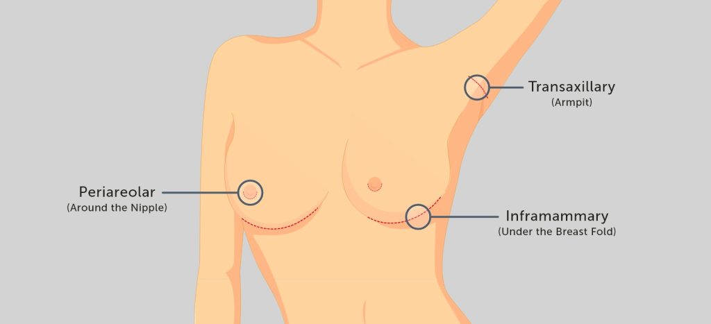 Diagram of incision options for breast augmentation