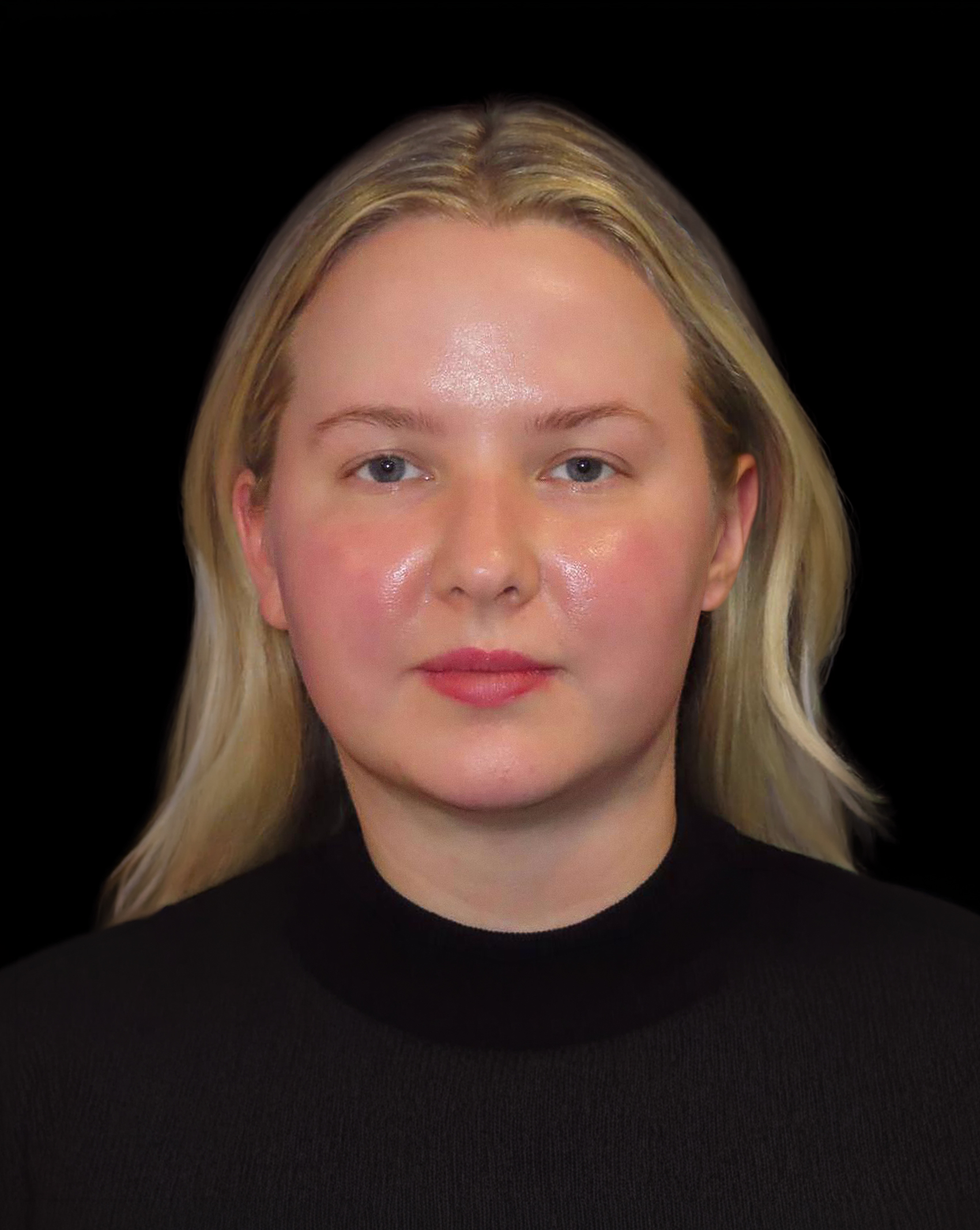Patient photographed facing the camera after liposuction, a neck lift and Smartlipo