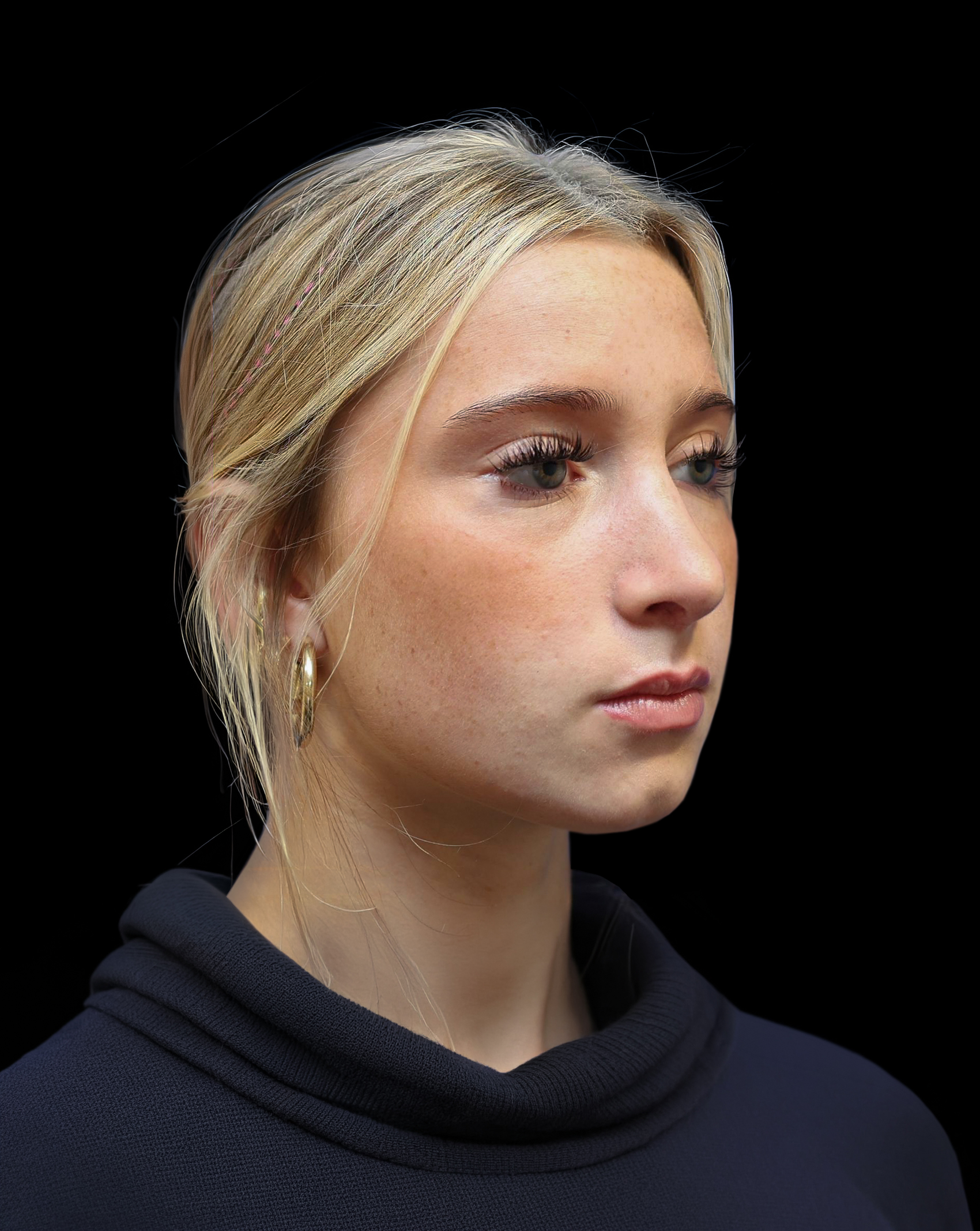 Patient photographed in three-quarter view after rhinoplasty