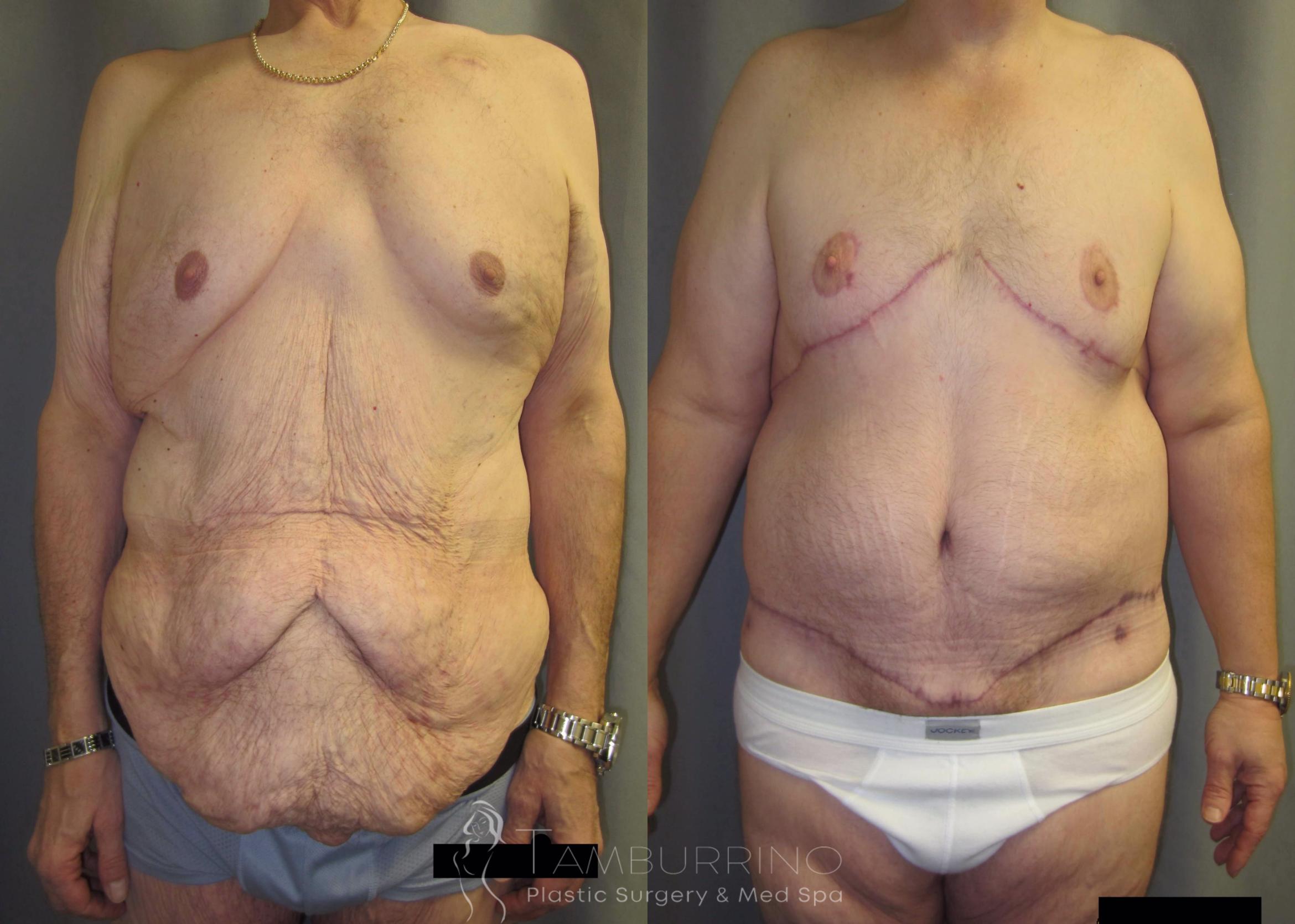 Before & After After Weight Loss Surgery Case 36 Front View in Doylestown, PA