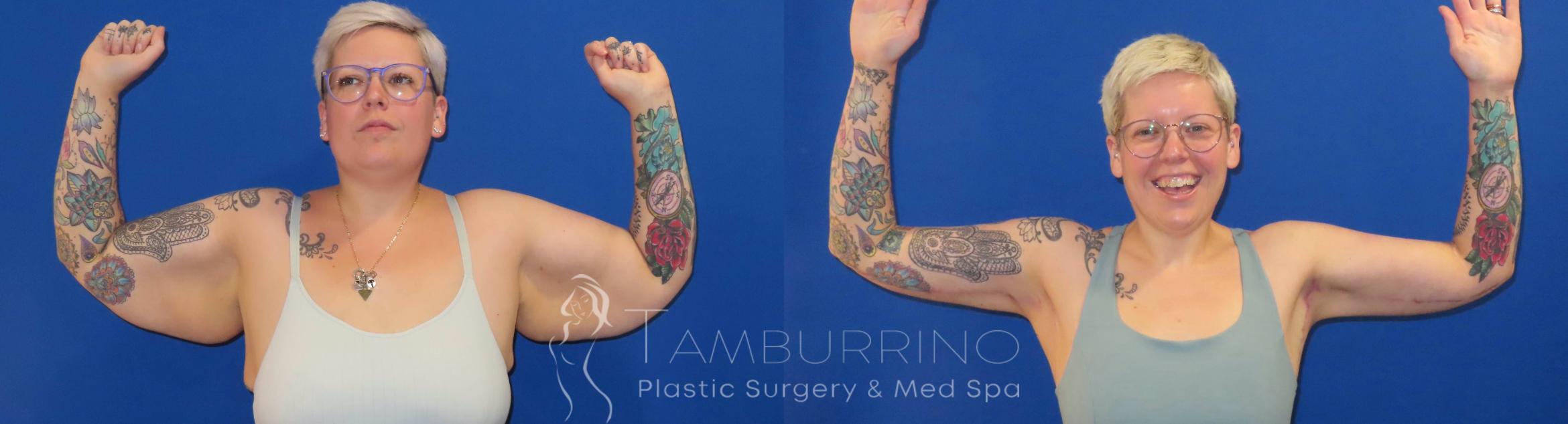 Before & After Arm Lift Case 73 Frontal View in Doylestown, PA