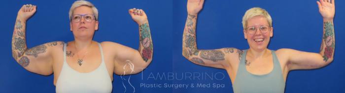 Arm Lift Before and After