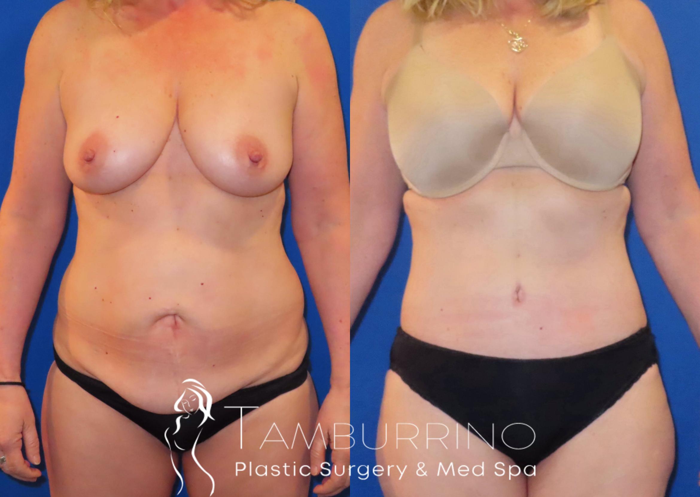 Before & After Body Contouring Case 29 Abdominoplasty Frontal View in Doylestown, PA
