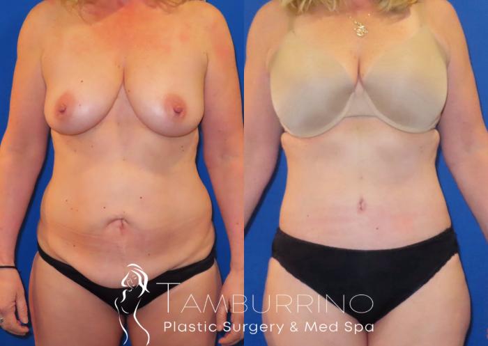 Before & After Tummy Tuck Case 29
