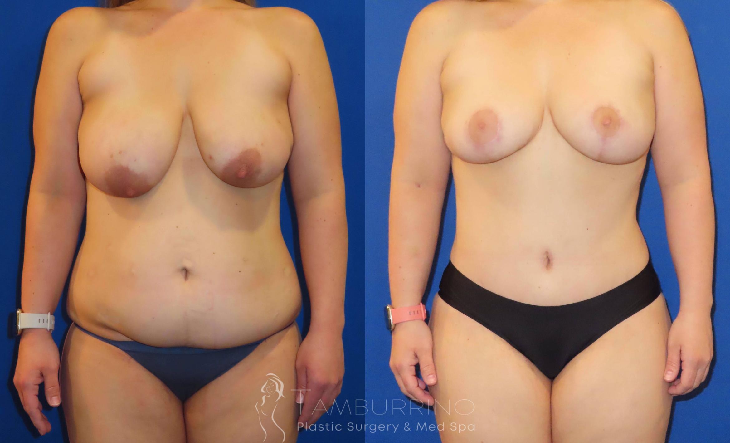 Before & After Body Contouring Case 31 Mommy Makeover Frontal View in Doylestown, PA