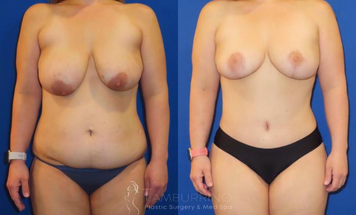 Before & After Breast Reduction Case 31