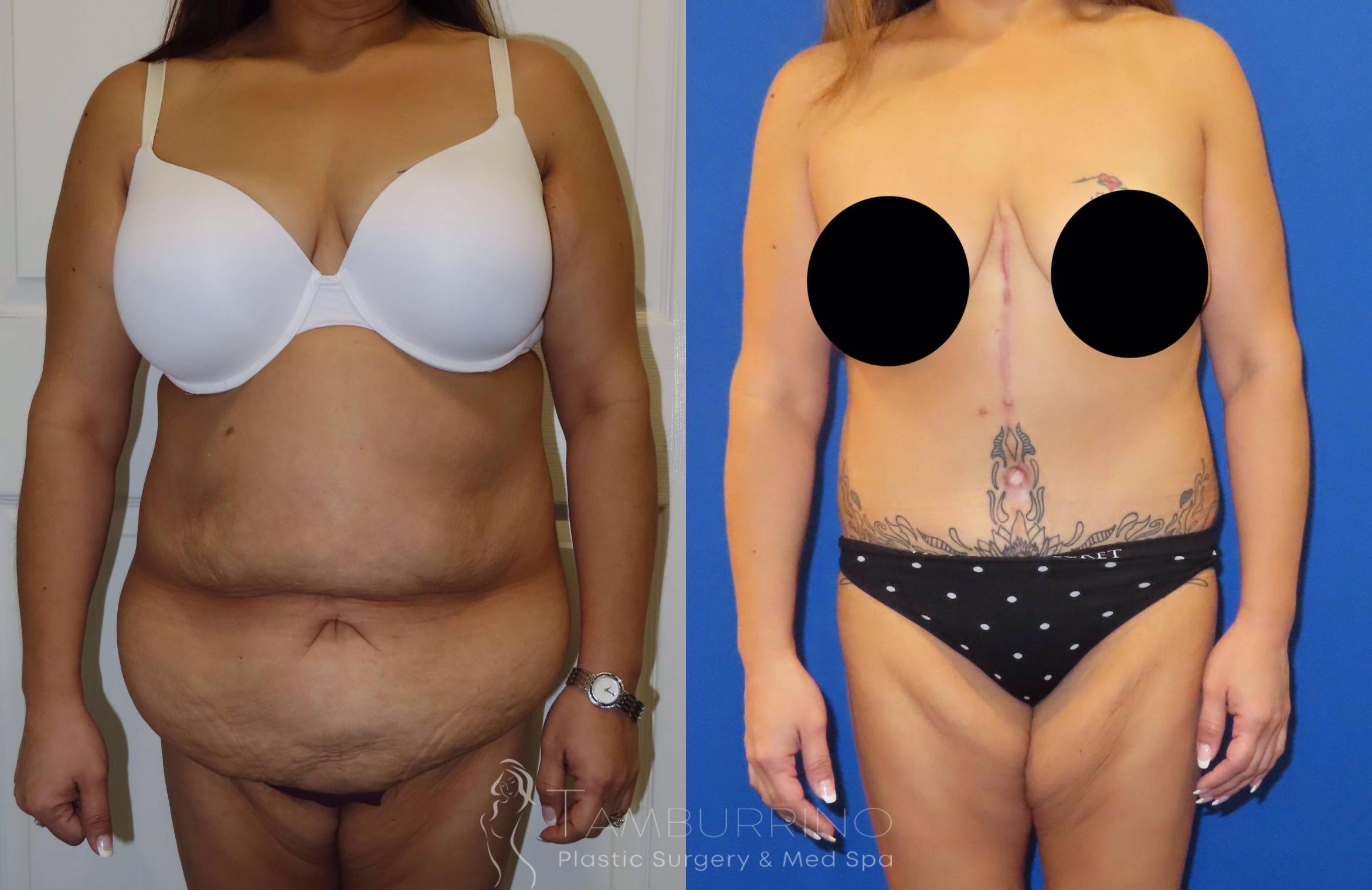 Before & After Body Contouring Case 37 Tummy Tuck Front View in Doylestown, PA