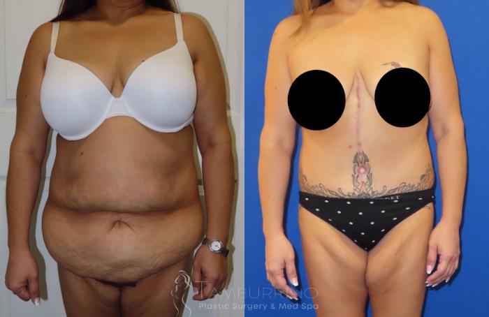 Before & After Tummy Tuck Case 37