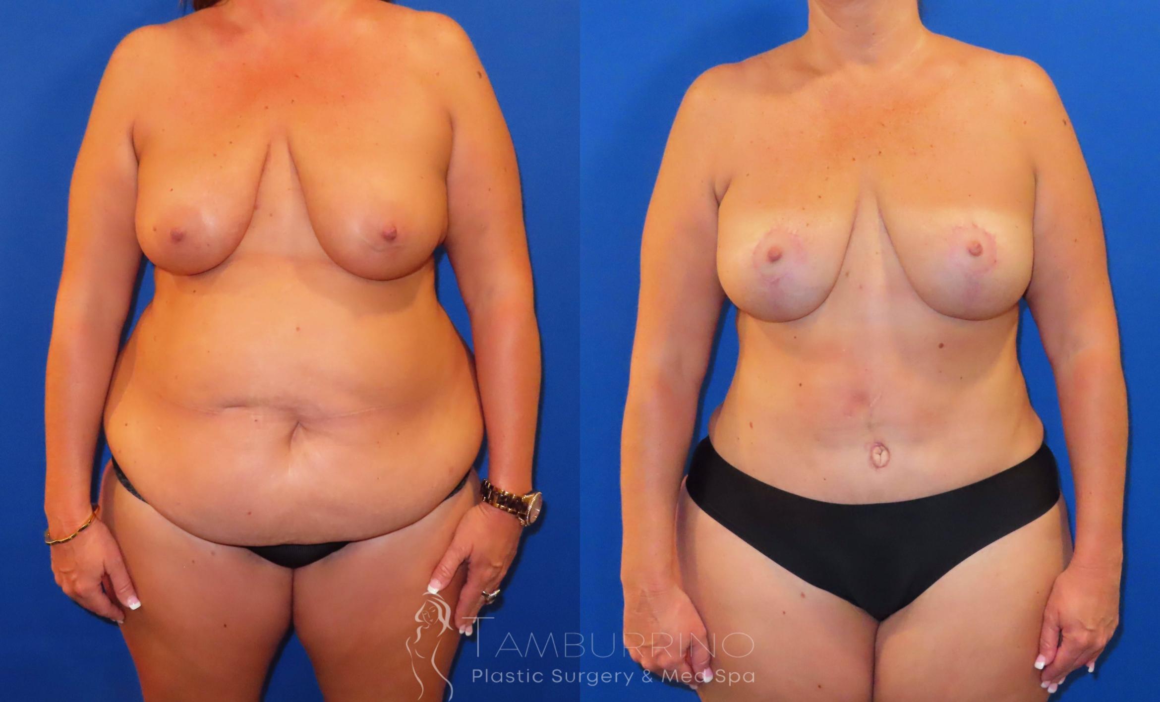 Before & After Body Contouring Case 38 Front View in Doylestown, PA