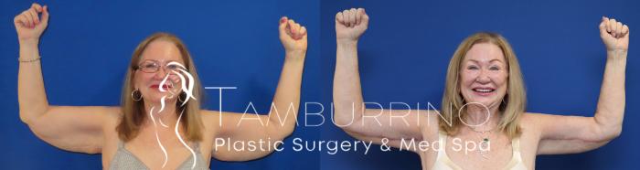 Before & After Body Contouring Case 74