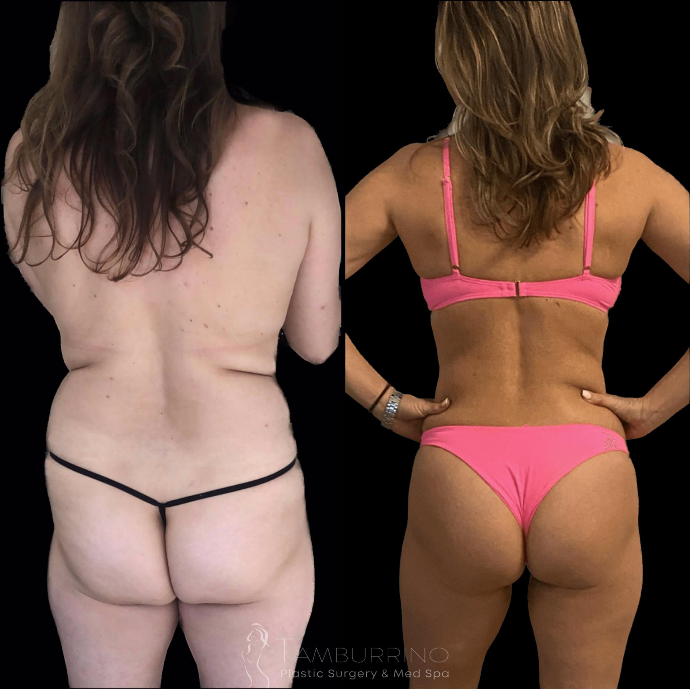 Before & After Brazilian Butt Lift Case 68 Back View in Doylestown, PA