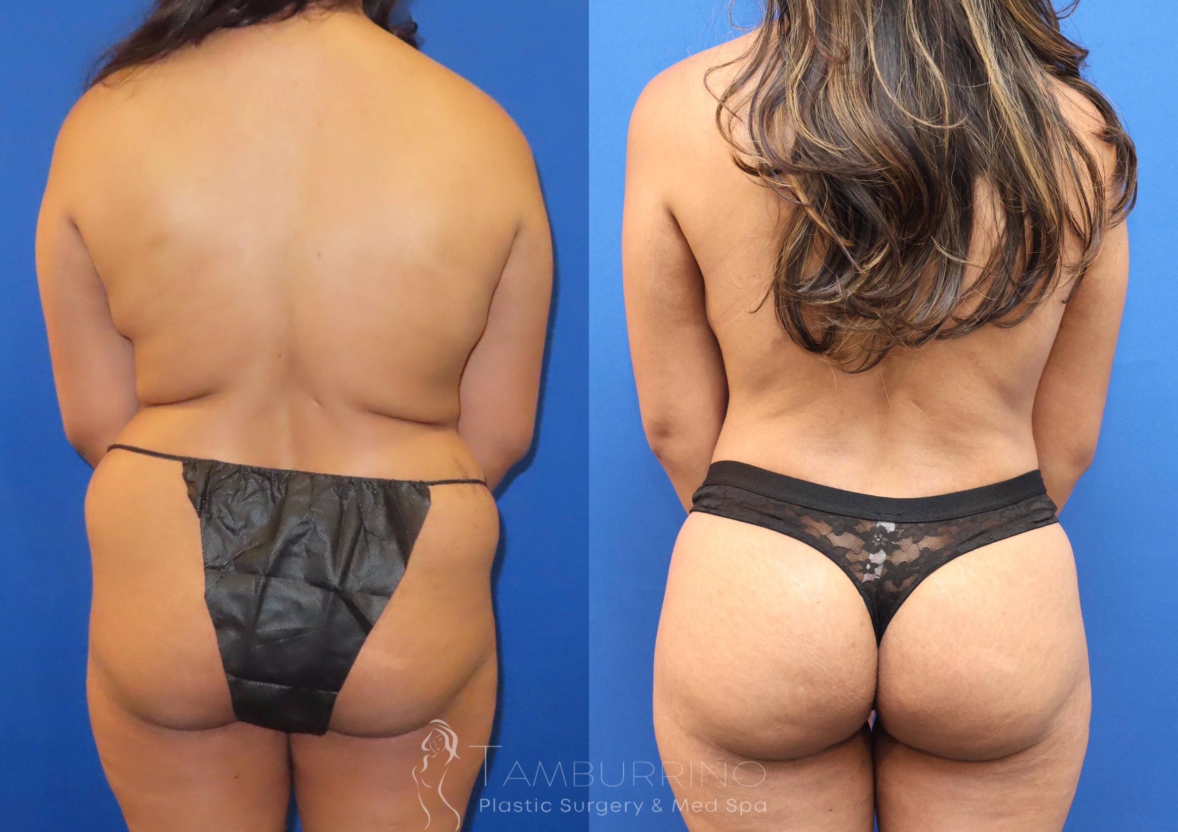 Before & After Brazilian Butt Lift Case 70 Back View in Doylestown, PA