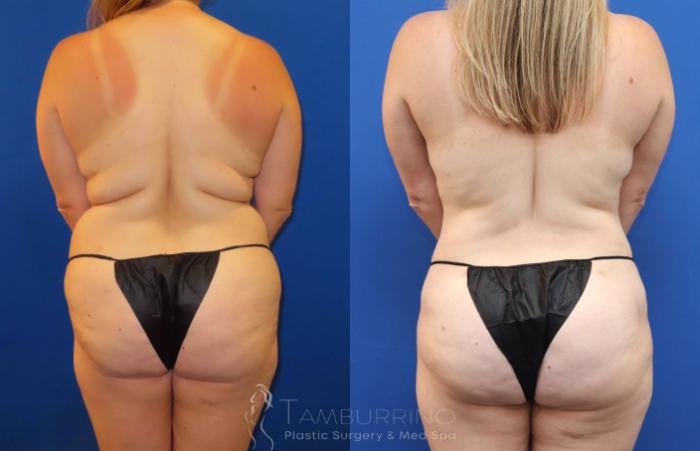 Before & After Brazilian Butt Lift Case 71