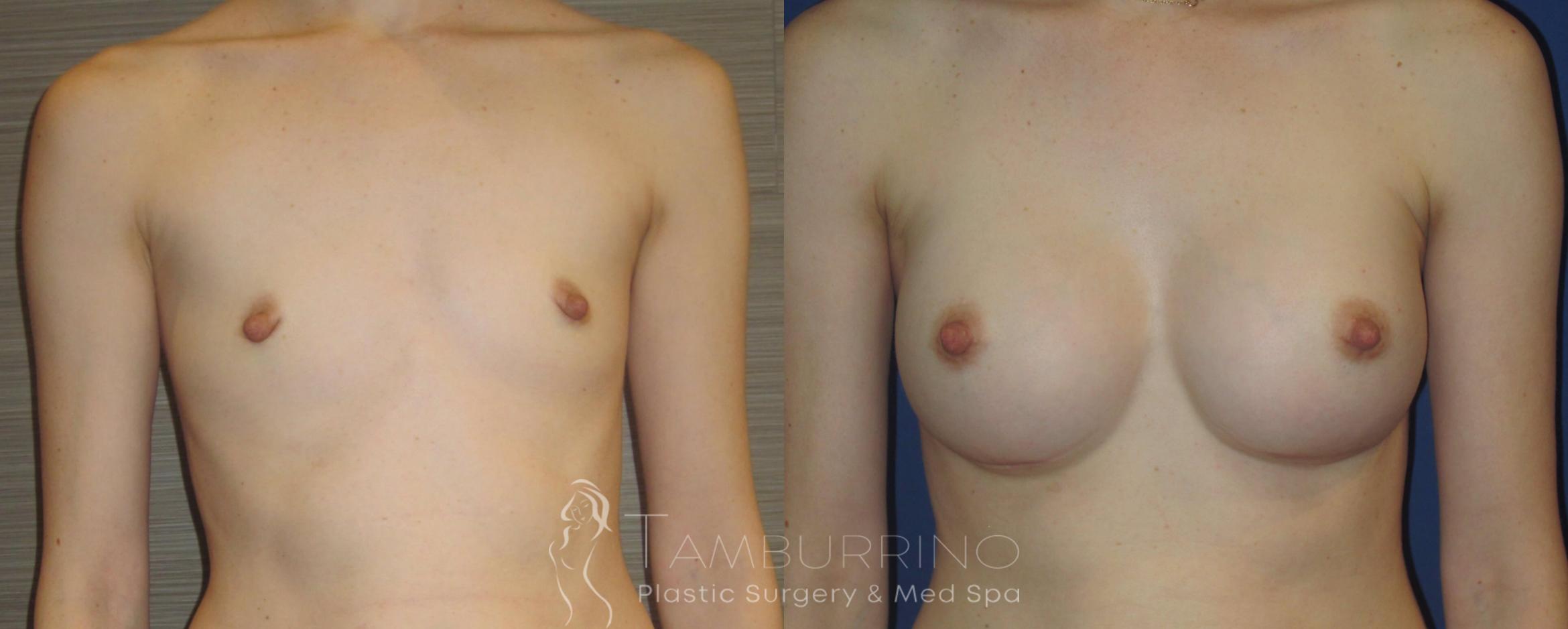 Before & After Breast Augmentation Case 15 Frontal View in Doylestown, PA