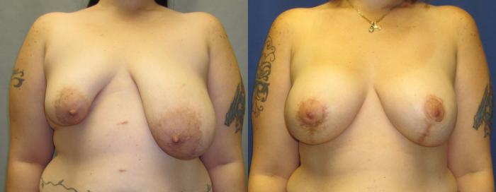 Before & After Breast Reduction Case 17