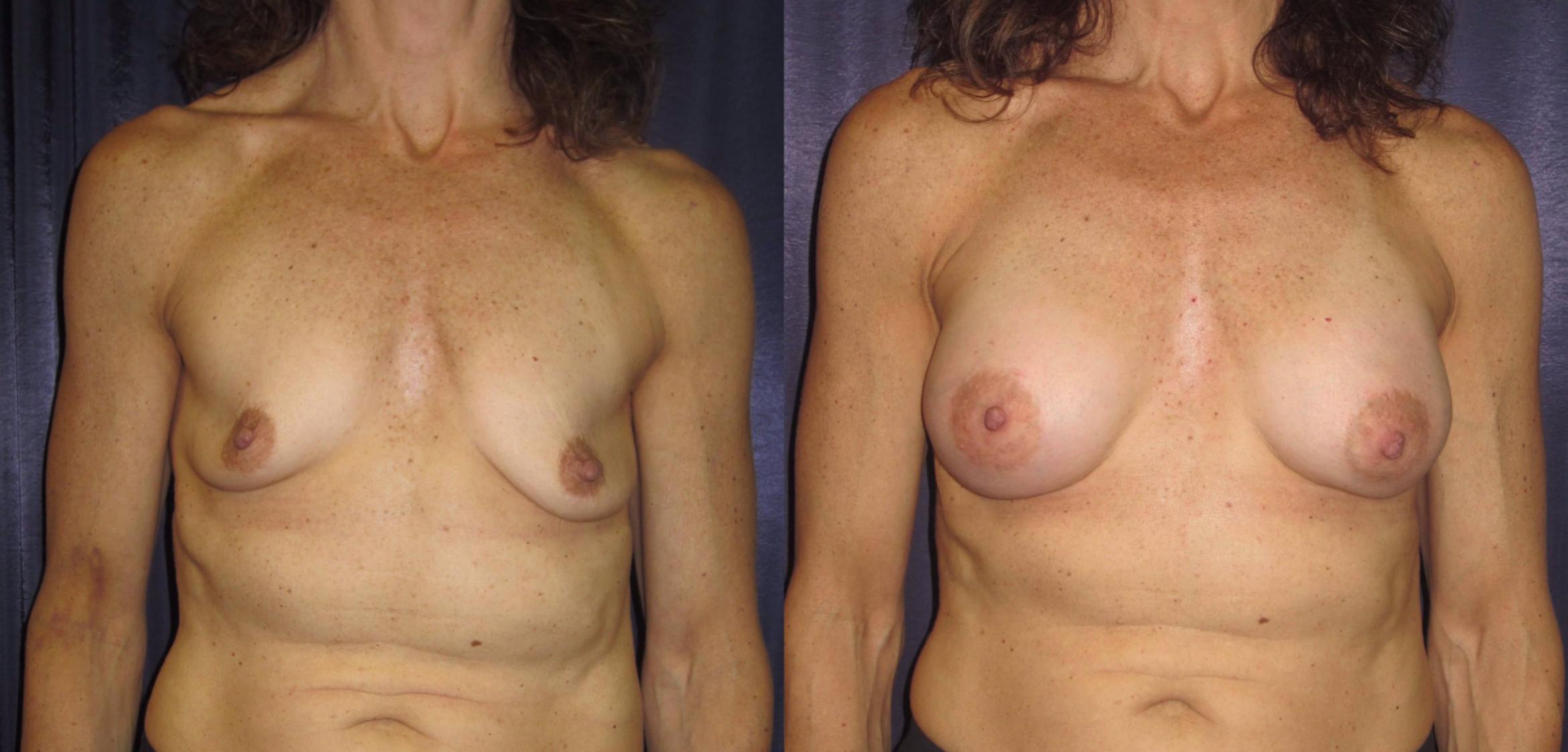 Before & After Breast Augmentation Case 2 Frontal View in Doylestown, PA