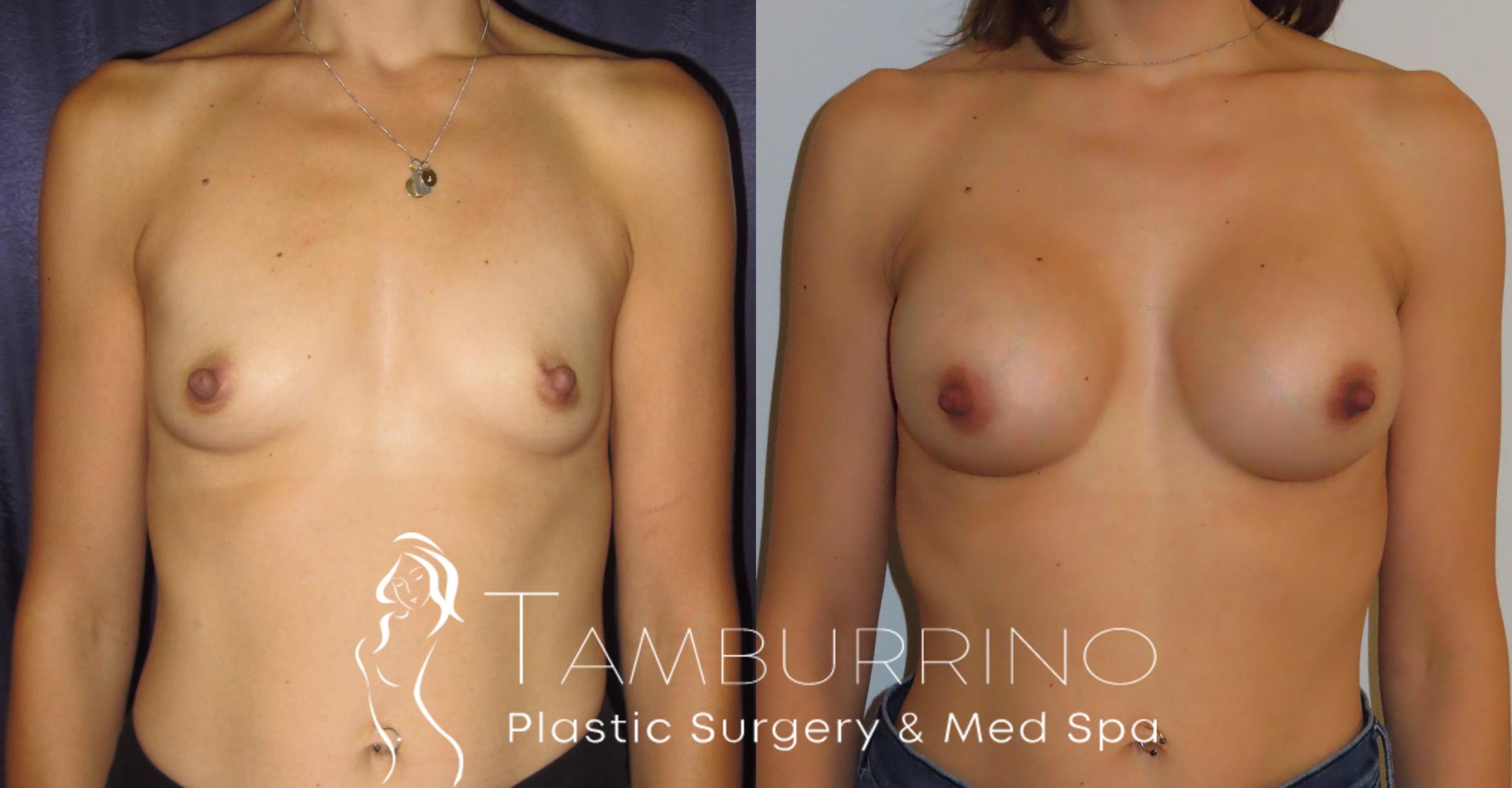 Before & After Breast Augmentation Case 3 Frontal View in Doylestown, PA