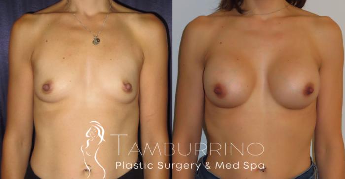 Before & After Breast Augmentation Case 3