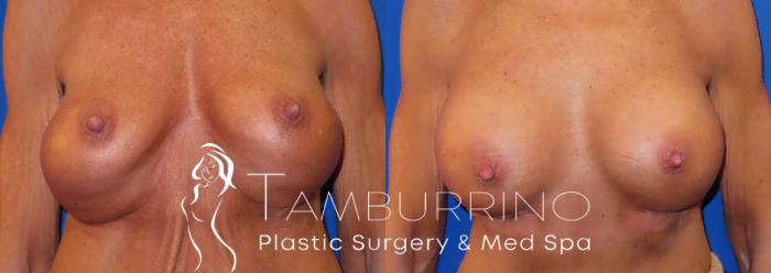 Before & After Breast Augmentation Case 32