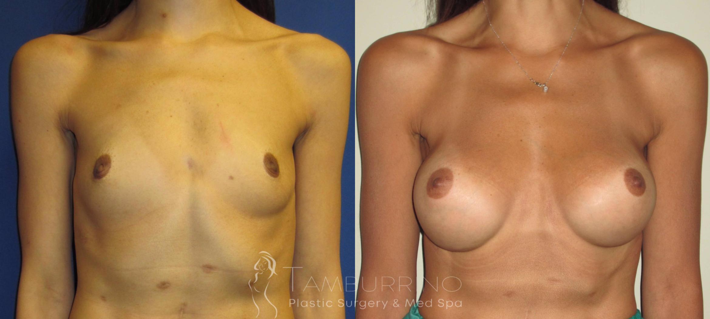 Before & After Breast Augmentation Case 4 Frontal View in Doylestown, PA