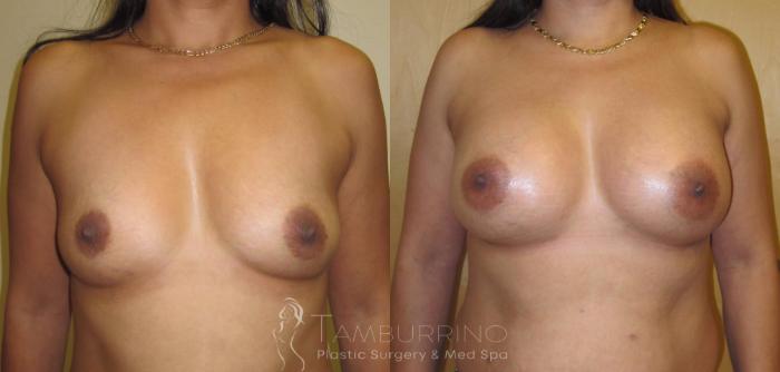 Before & After Breast Augmentation Case 5