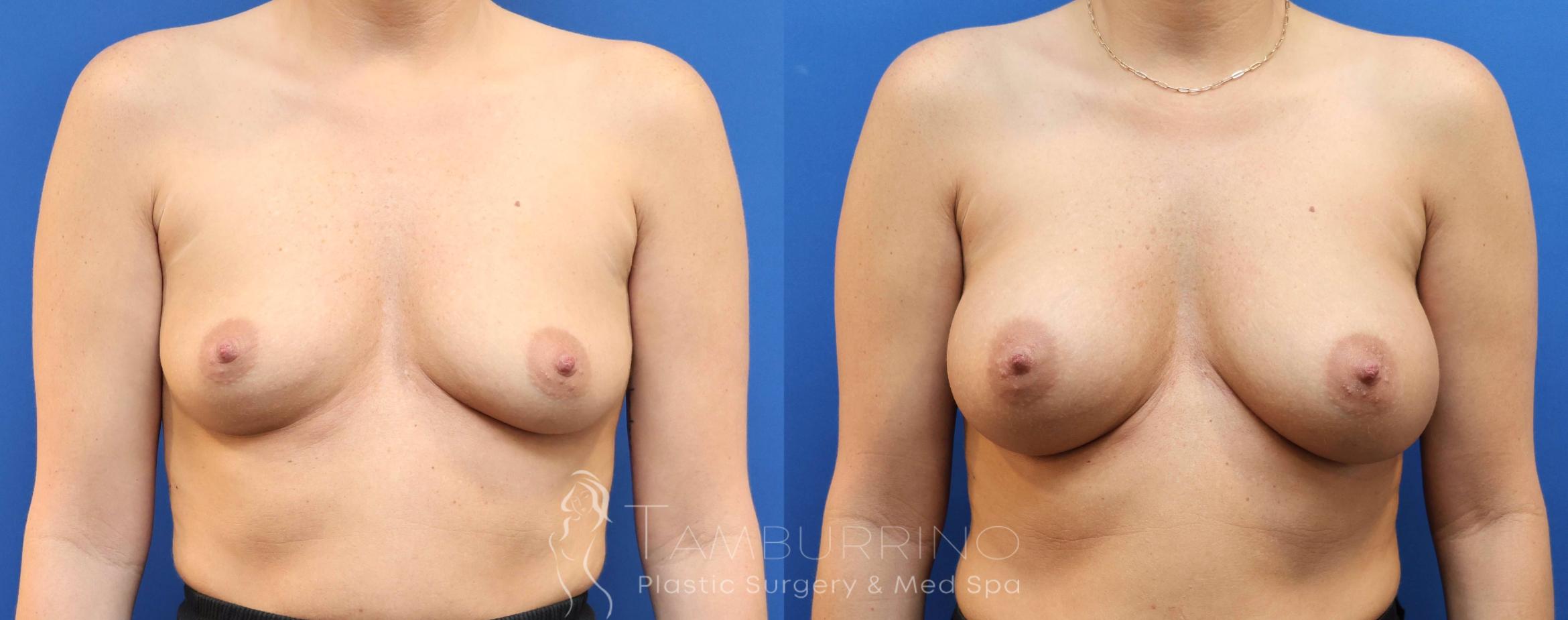 Before & After Breast Augmentation Case 77 Front View in Doylestown, PA