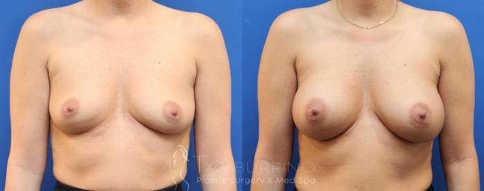 Before & After Breast Augmentation Case 77