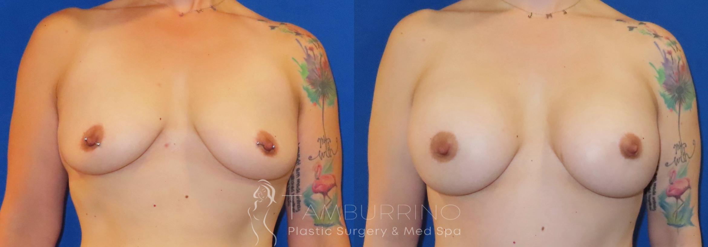 Before & After Breast Augmentation Case 80 Front View in Doylestown, PA
