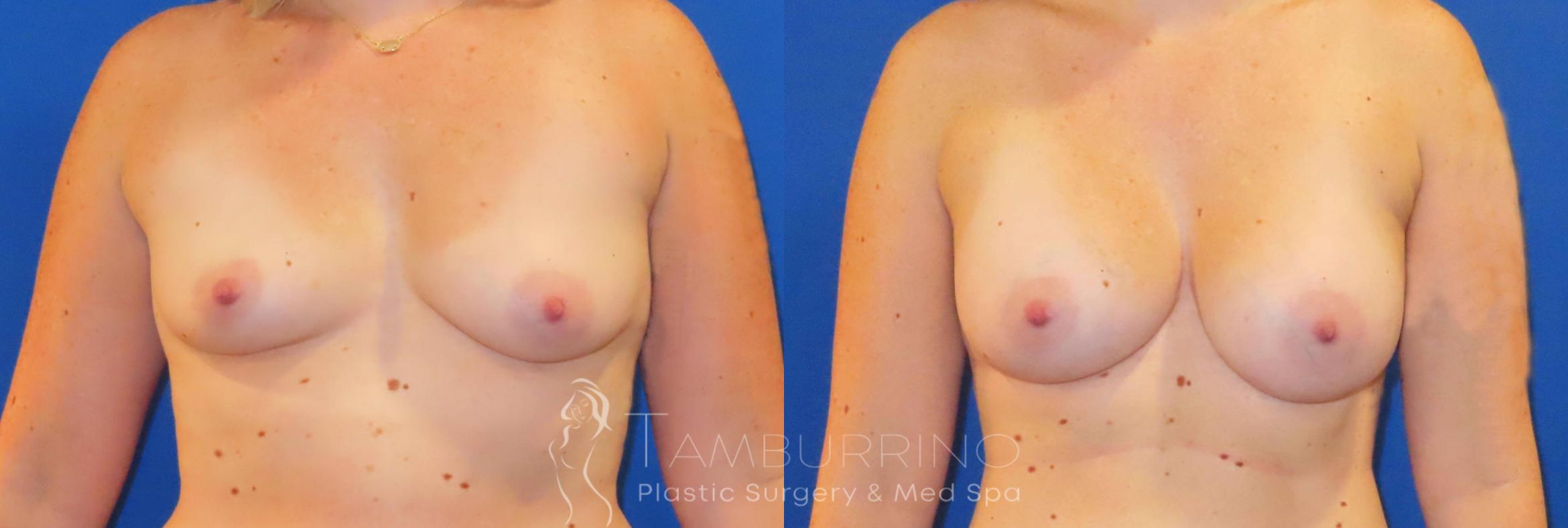 Before & After Breast Augmentation Case 82 Front View in Doylestown, PA