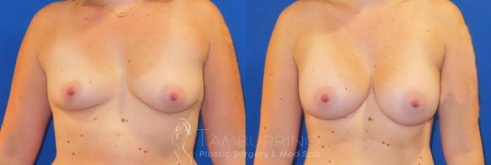 Before & After Breast Augmentation Case 82