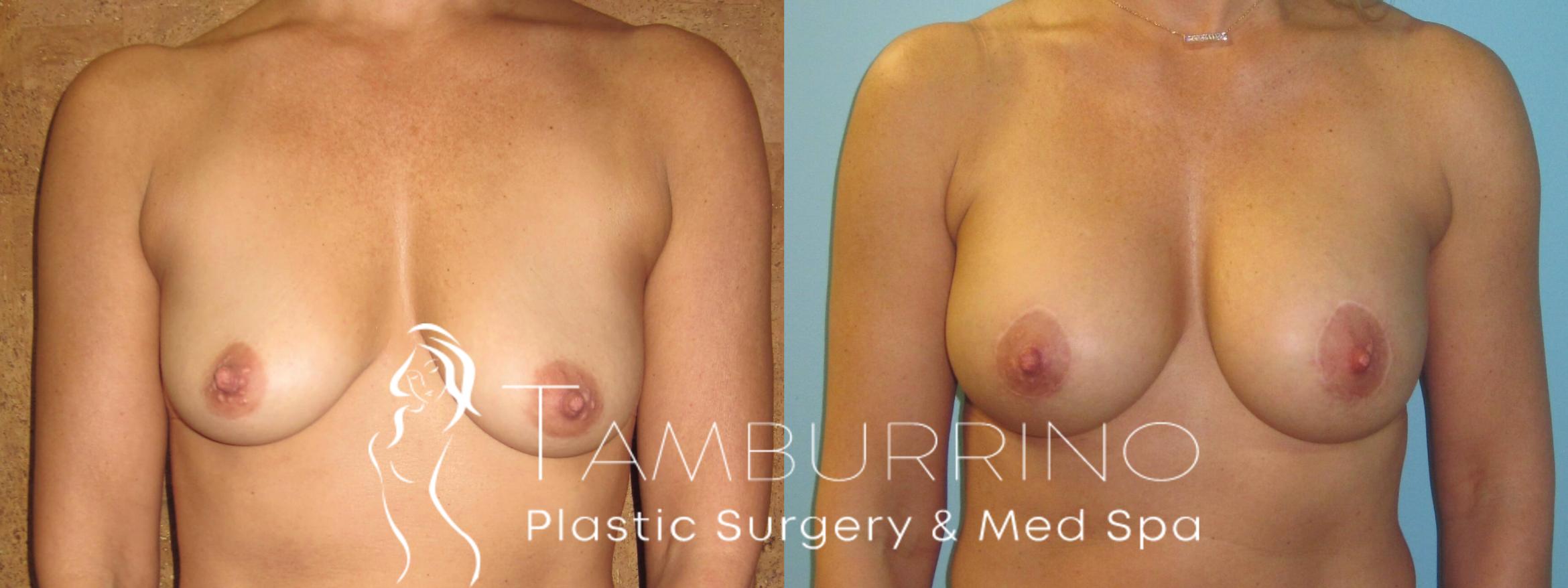 Before & After Breast Lift Case 13 Frontal View in Doylestown, PA