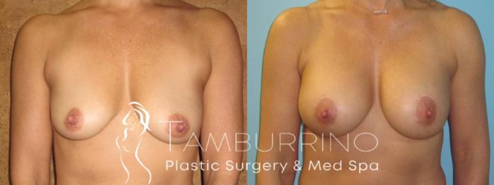 Breast Lift Before and After