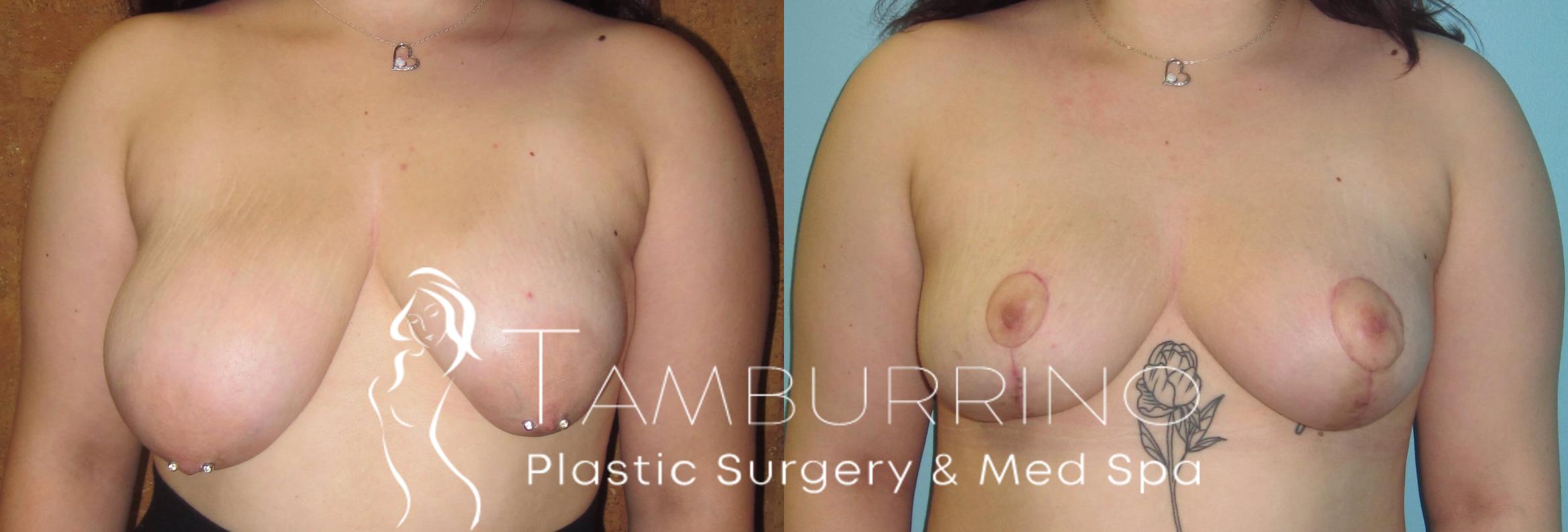 Before & After Breast Lift Case 16 Frontal View in Doylestown, PA