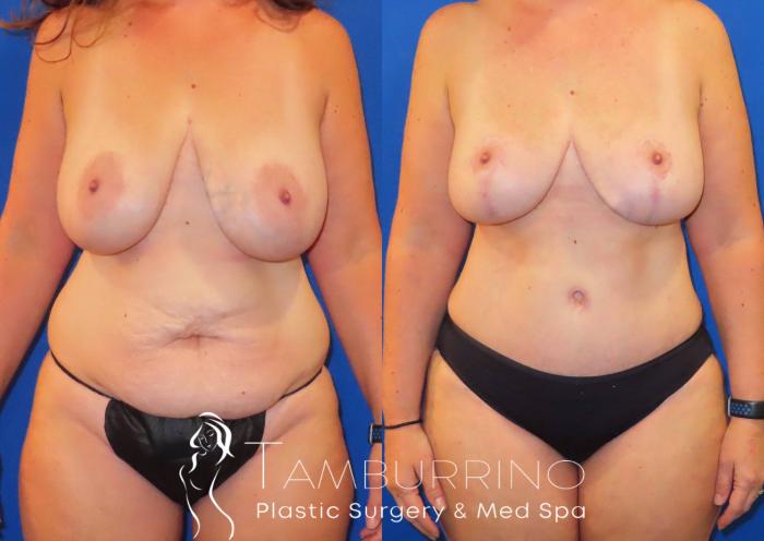 Before & After Breast Reduction Case 30