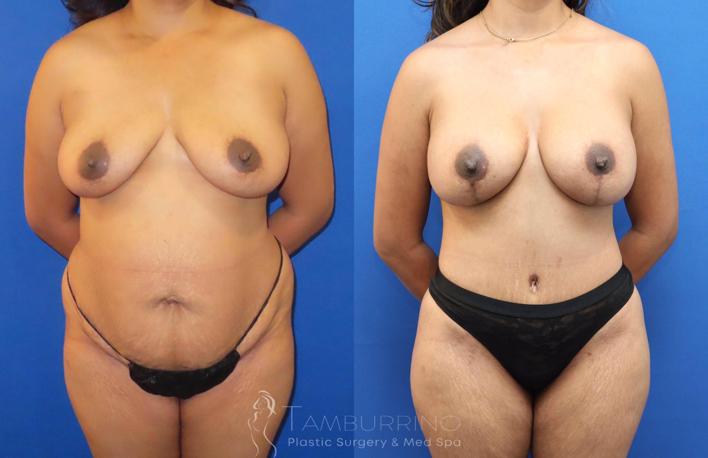 Before & After Breast Lift Case 69 Frontal View in Doylestown, PA
