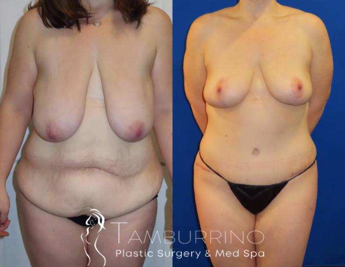 Body Contouring Before and After