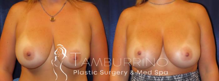Before & After Breast Augmentation Case 10