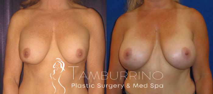 Breast Revision Before and After