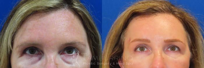 Brow Lift Before and After