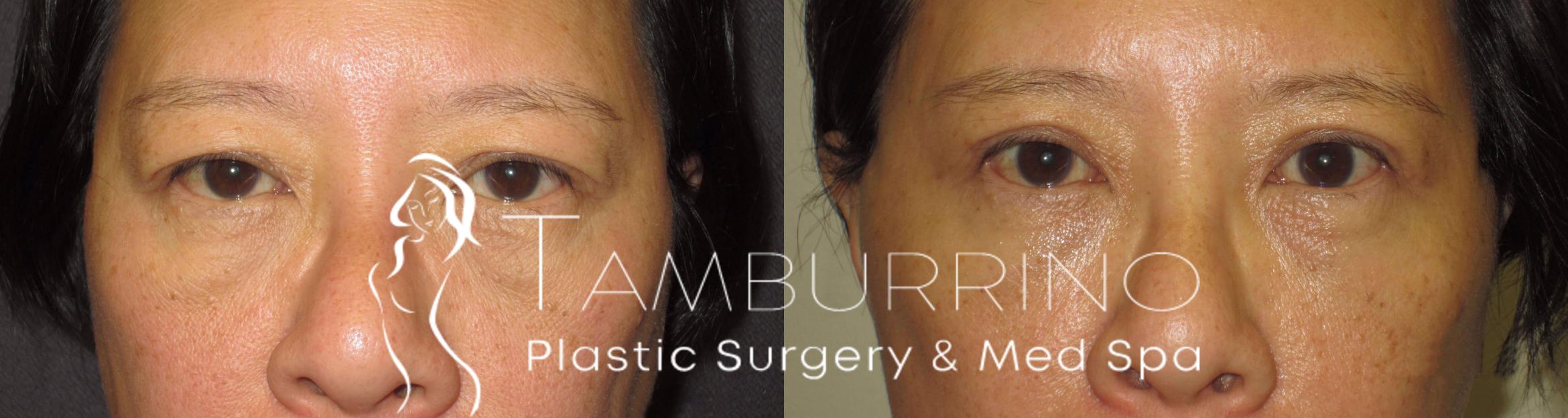 Before & After Eyelid Lift Case 43 Frontal View in Doylestown, PA