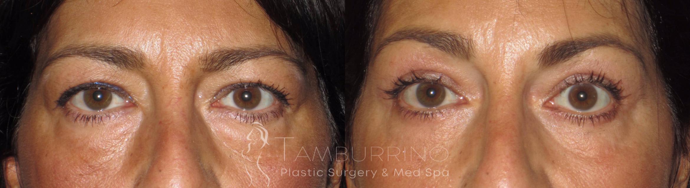 Before & After Eyelid Lift Case 45 Frontal View in Doylestown, PA