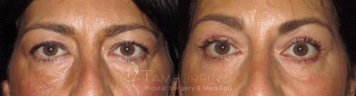 Before & After Eyelid Lift Case 45