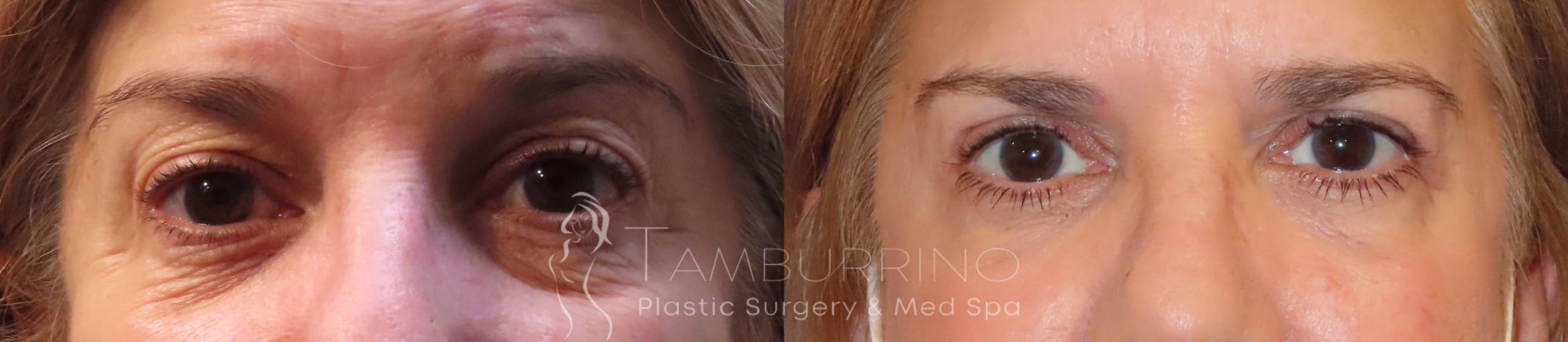 Before & After Eyelid Lift Case 46 Frontal View in Doylestown, PA