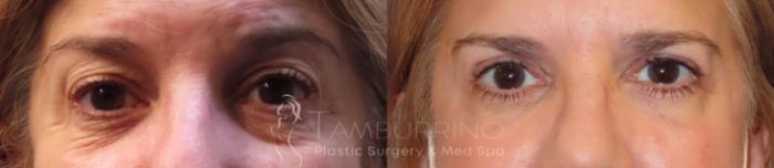 Before & After Eyelid Lift Case 46