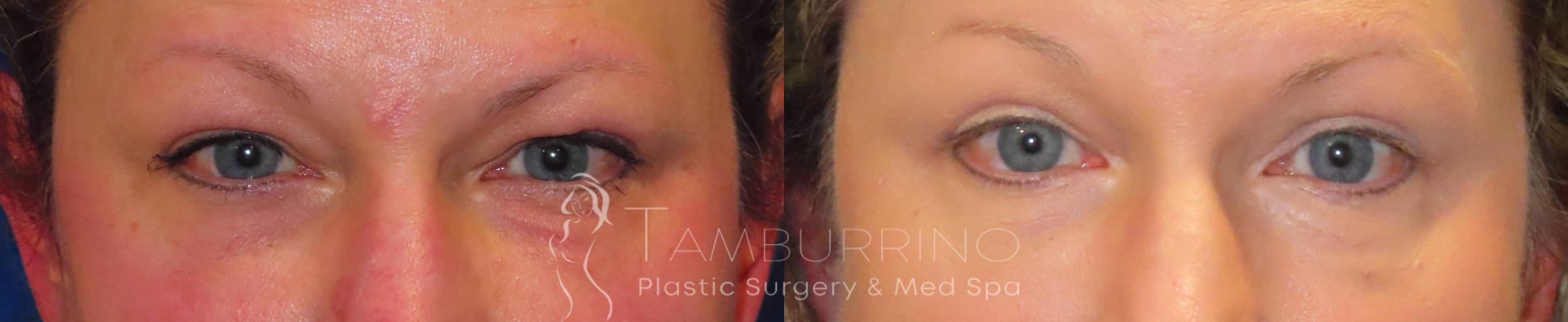 Before & After Eyelid Lift Case 47 Frontal View in Doylestown, PA