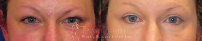 Before & After Eyelid Lift Case 47