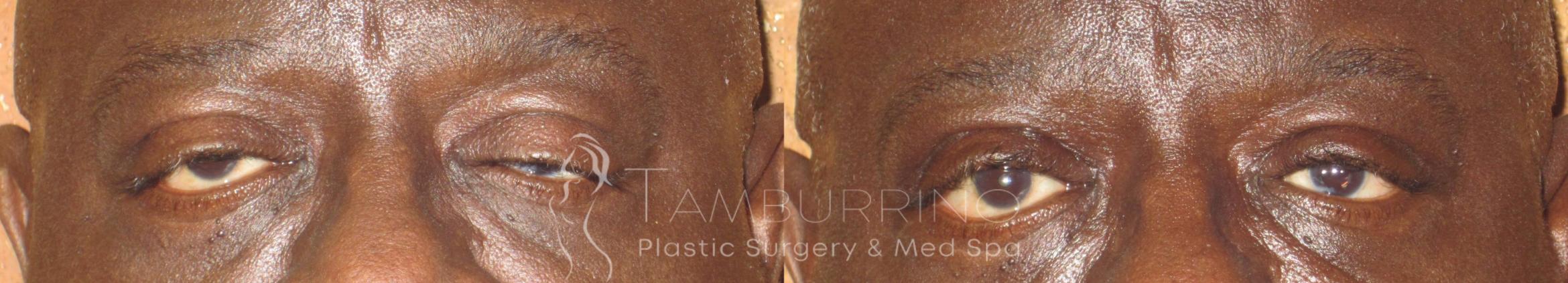 Before & After Eyelid Lift Case 48 Frontal View in Doylestown, PA