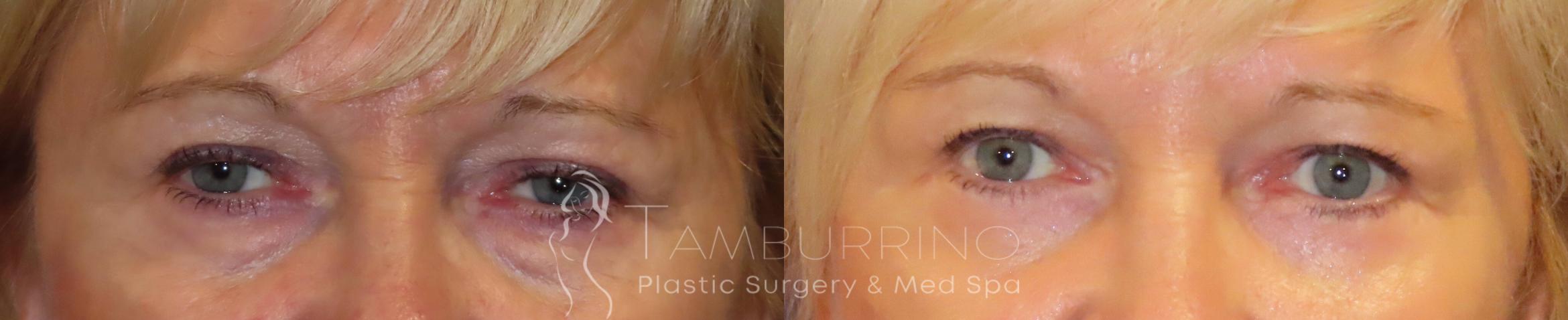 Before & After Eyelid Lift Case 49 Frontal View in Doylestown, PA