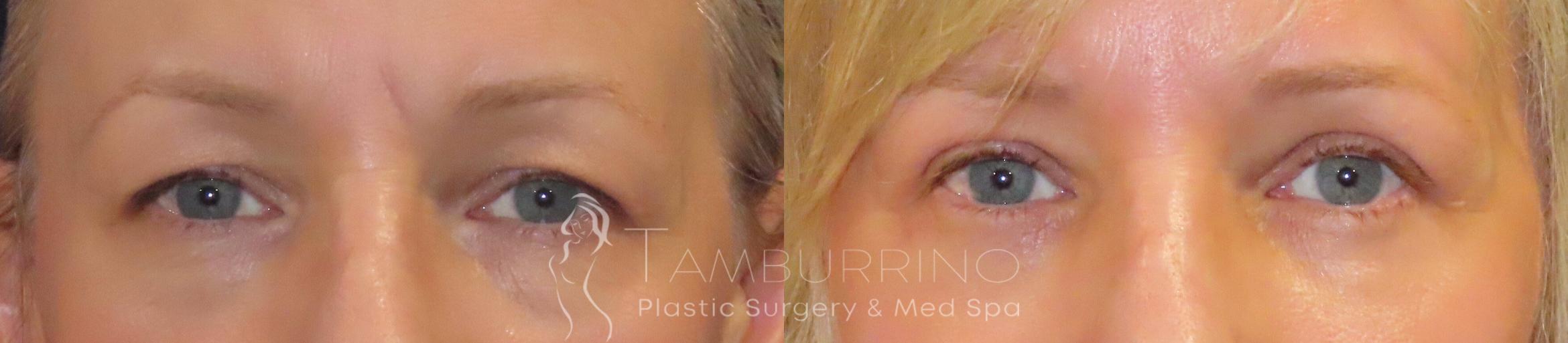 Before & After Eyelid Lift Case 50 Frontal View in Doylestown, PA